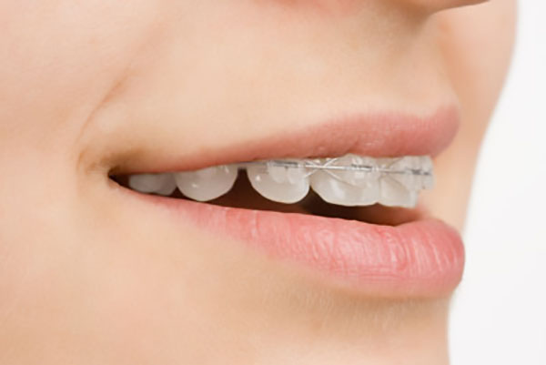 Reasons To Consider Clear Braces