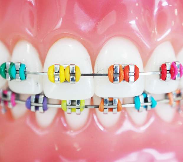 Be Vigilant With Dental Care While Wearing Braces - Henry Orthodontics  Pinehurst, North Carolina