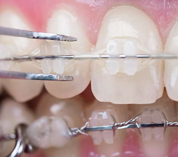 Be Vigilant With Dental Care While Wearing Braces - Henry Orthodontics  Pinehurst, North Carolina