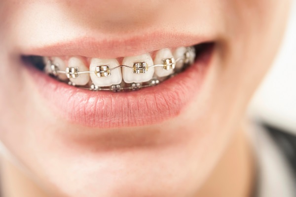 Dental Braces Treatment Details