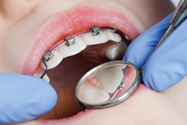 How A Braces Specialist Makes For A More Comfortable Treatment