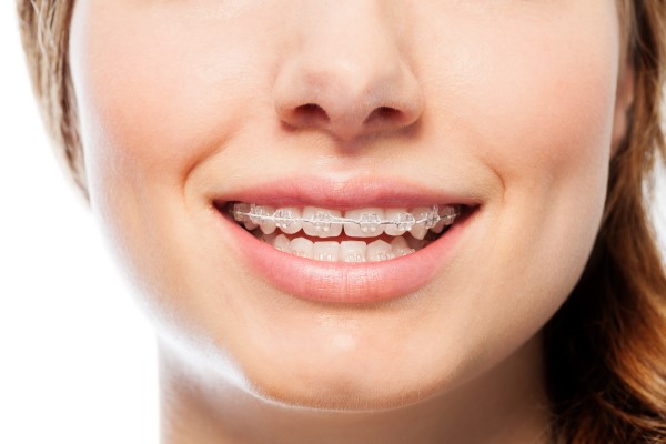 How Long Do Cosmetic Braces Take To Straighten Teeth?