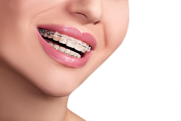 What Adults Should Know About Teeth Straightening Options from an