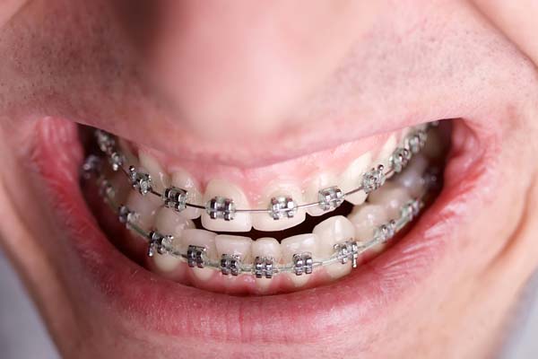 Preparing For Your First Orthodontic Visit