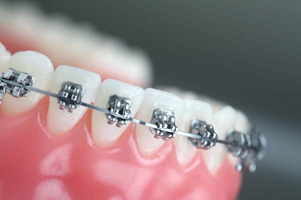 Reasons For Orthodontist Treatments For Adults