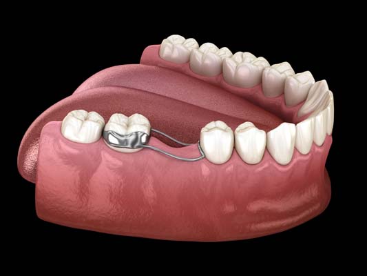 The benefits of space maintainers and clear braces in preventing dental  issues